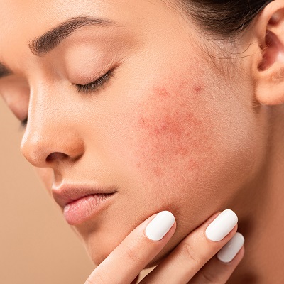 A Comprehensive Guide to Treating Acne